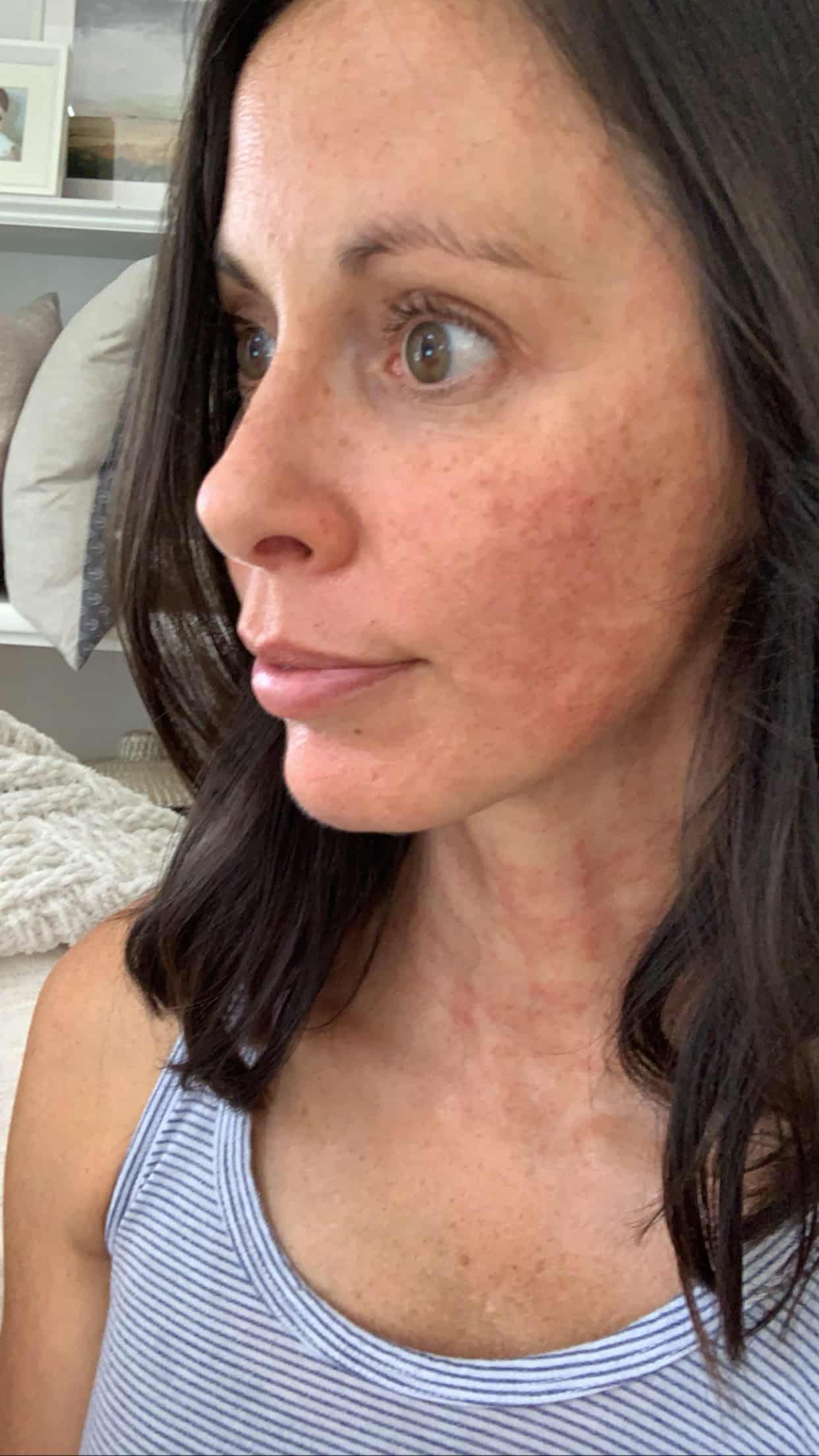 My face a few hours after my Morpheus8 procedure - minimal redness and otherwise clear skin.