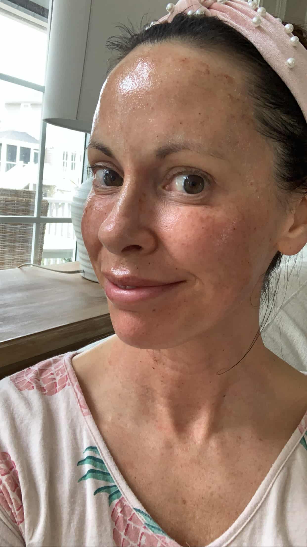 My face after my Morpheus8 procedure, with just a little redness.
